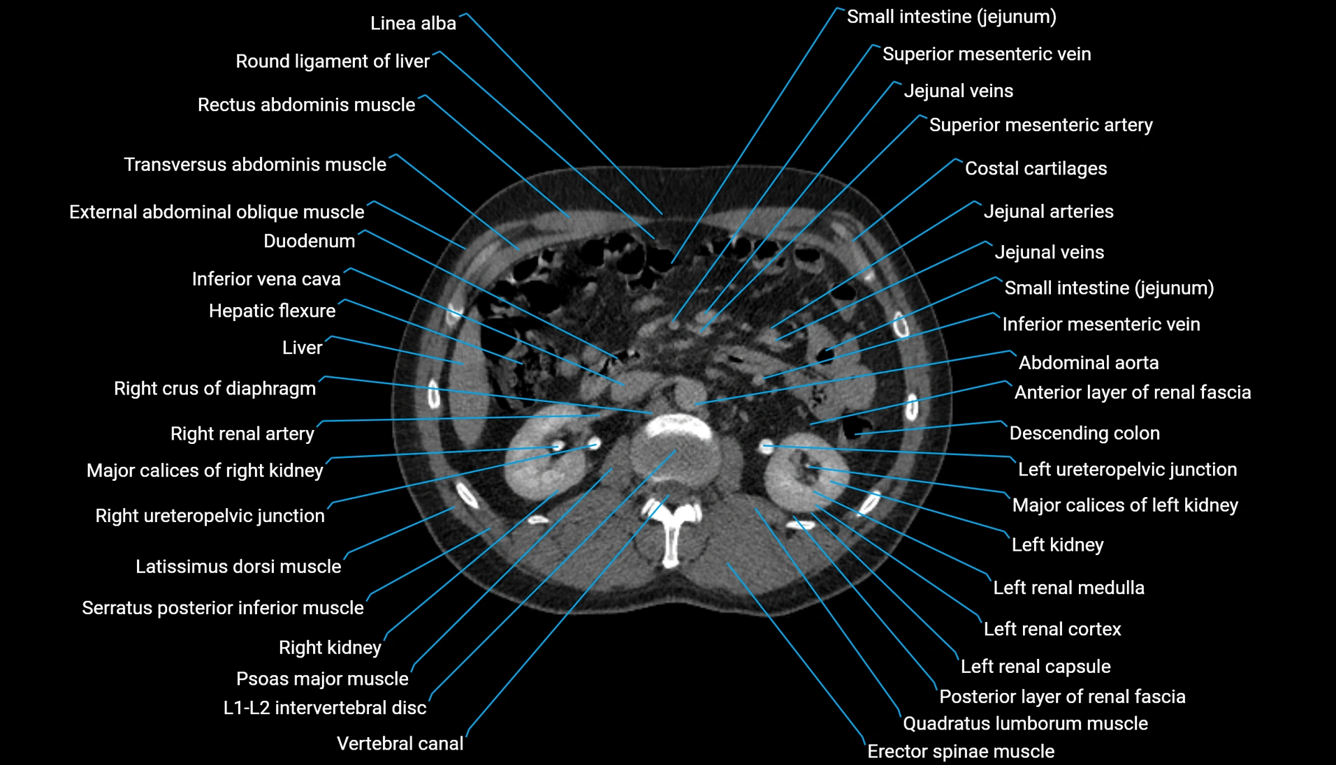 CT urogram axial cross sectional anatomy  labelled radiology image-00106.webp